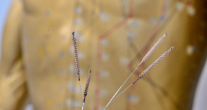 Acupuncture needles at Acupuncture Center Frankfurt