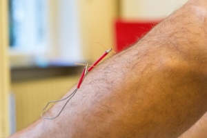Electrical stimulation at Acupuncture Center Frankfurt